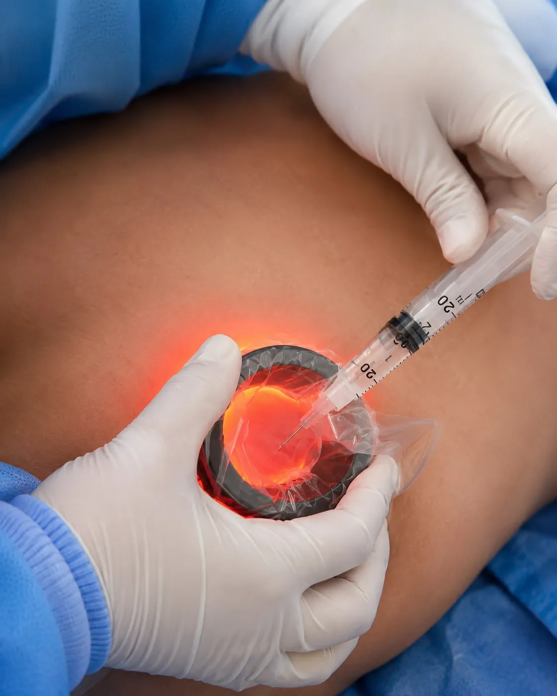 Aplicación de escleroterapia con un visor de venas que ilumina la piel